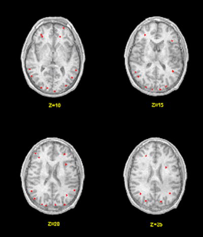 brain-scan-of-hearing-name-ncbi.nlm.nih.gov